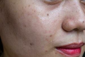 Black spots, scars and acne on the face of Asian woman. photo