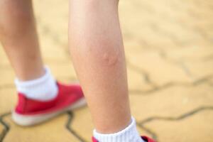 The boy's leg was bitten by a mosquito. There is a rash in the area where the mosquito bites were bitten. photo