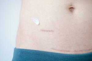 Using cream to care for scars after appendix surgery and postpartum surgical wounds photo
