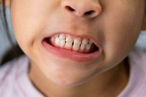 Headshot cropped image of cute preschool girl smiling wide showing milk teeth. Close-up of a child's white teeth. photo