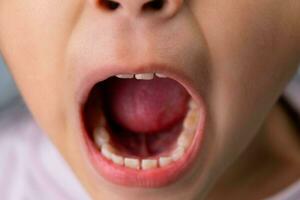 Headshot cropped image of cute preschool girl smiling wide showing milk teeth. Close-up of a child's white teeth. photo