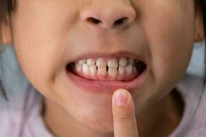 Headshot cropped image of cute preschool girl smiling wide showing milk teeth. Close-up of a child's white teeth. photo