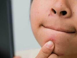 cerca arriba de joven mujer apretando espinillas en su rostro. problemático piel en pelinegro asiático mujer. concepto de piel problemas y piel cuidado. foto