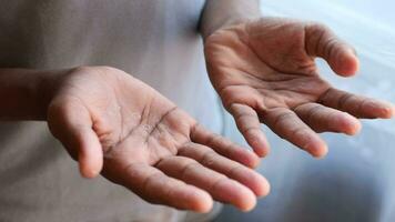 dichtbij omhoog van droog gebarsten huid van een Mannen hand- video