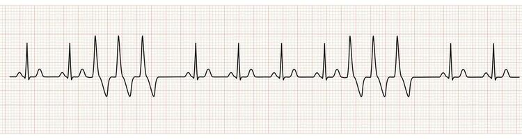 EKG Monitor Showing  Sinus Rhythm with Short Run VT vector