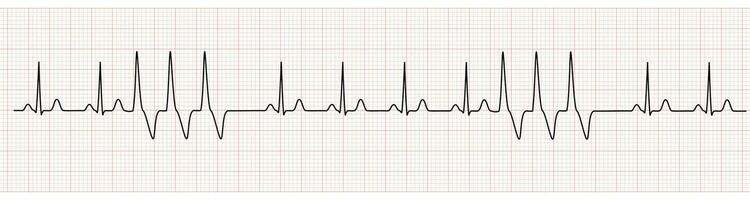 EKG Monitor Showing  Sinus Rhythm with Short Run VT vector