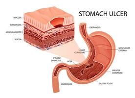 Peptic ulcer in stomach infographic vector