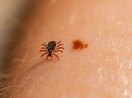 close up of red tick with blood. macro shot of human hand with tick. photo