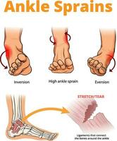 illustration of ankle sprains types vector