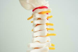 Spinal nerve and bone, Lumbar spine displaced herniated disc fragment, Model for treatment medical in the orthopedic department. photo