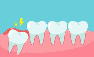 Impacted wisdom tooth cause pain in the mouth.Dental care concept vector