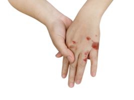 Hands with blisters from heat PNG transparent