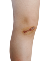 Frais blessure sur le genou png transparent