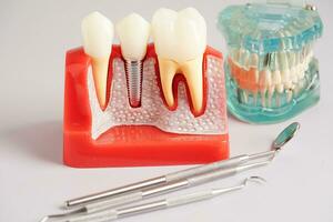 dental implante, artificial diente raíces dentro mandíbula, raíz canal de dental tratamiento, goma enfermedad, dientes modelo para dentista estudiando acerca de odontología. foto