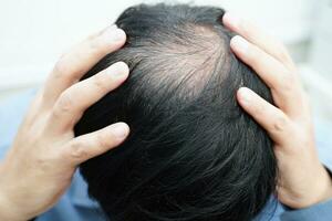 calvo cabeza en hombre, pelo pérdida tratamiento salud problema. foto