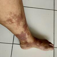 Horrible burns on left leg. Burns due to being scalded by hot water. Blistered skin. Reddish skin photo