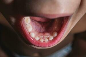 The boy's molars are erupting when the milk teeth have not yet fallen out. Anomaly. Close-up photo