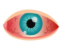 rojo ojo conjuntivitis. vector ilustración