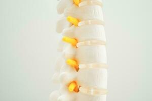 Spinal nerve and bone, Lumbar spine displaced herniated disc fragment, Model for treatment medical in the orthopedic department. photo