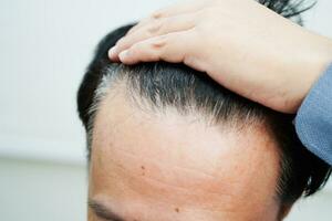 calvo cabeza en hombre, pelo pérdida tratamiento salud problema. foto