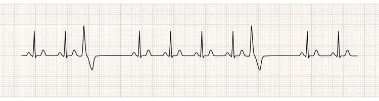 EKG Monitor Showing  Sinus Rhythm with PVC vector