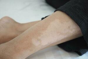feet with vitiligo skin condition. photo