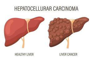 Hepatocellular carcinoma, liver diseases. Healthy liver and liver cancer. Medical infographic banner. Vector