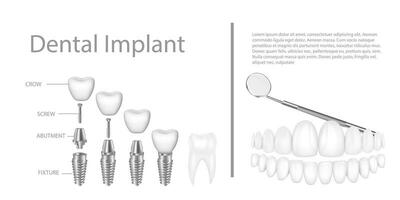 dental implante estructura médico pictórico educativo infografía póster con molar reemplazo final sano herramientas modelos vector ilustración.