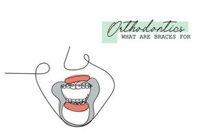 Continuous line art of Orthodontic treatment. Dentists day and respect for their services to humanity vector