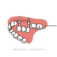 Continuous line art of Orthodontic treatment. Dentists day and respect for their services to humanity vector