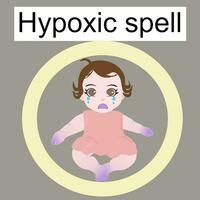 The sign of hypoxia spell or TOF spell there are the sign of central and peripheral cyanosis for medical and education information vector