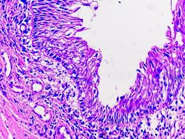 Histology of urachal cyst. Photomicrograph of histological stained slide showing Urachal cyst. Urethral cyst. photo
