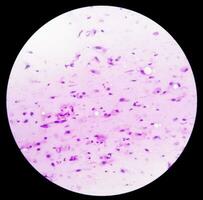 Photomicrograph showing Neurofibroma. Neurofibromatosis, is a genetic disorder, gene mutations. photo