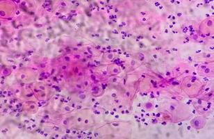 microfotografía de paparazzi frotis demostración inflamatorio frotis con hpv relacionado cambios. cervical cáncer. scc foto