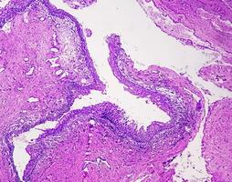 Histology of urachal cyst. Photomicrograph of histological stained slide showing Urachal cyst. Urethral cyst. photo