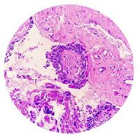 Histology of urachal cyst. Photomicrograph of histological stained slide showing Urachal cyst. Urethral cyst. photo