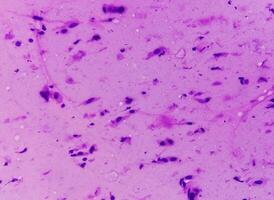 Photomicrograph showing Neurofibroma. Neurofibromatosis, is a genetic disorder, gene mutations. photo