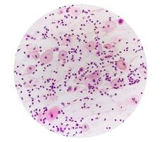 Photomicrograph of Paps smear showing Inflammatory smear with HPV related changes. Cervical cancer. SCC photo