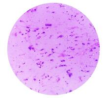 Photomicrograph showing Neurofibroma. Neurofibromatosis, is a genetic disorder, gene mutations. photo