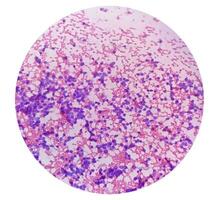 USG guided FNA cytology of liver SOL showing Non Hodgkin lymphoma. Metastatic carcinoma photo