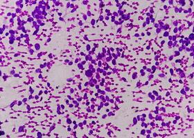 USG guided FNA cytology of liver SOL showing Non Hodgkin lymphoma. Metastatic carcinoma photo