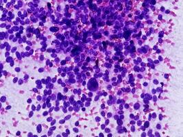 USG guided FNA cytology of liver SOL showing Non Hodgkin lymphoma. Metastatic carcinoma photo