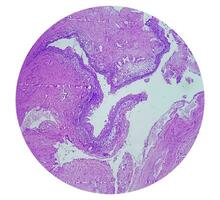 Histology of urachal cyst. Photomicrograph of histological stained slide showing Urachal cyst. Urethral cyst. photo