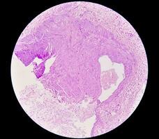 Photomicrograph, Prepatellar region histology showing Bursitis, acute or chronic Bursitis. photo