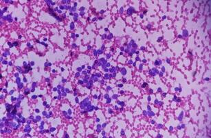 USG guided FNA cytology of liver SOL showing Non Hodgkin lymphoma. Metastatic carcinoma photo