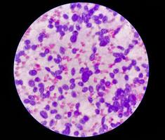 USG guided FNA cytology of liver SOL showing Non Hodgkin lymphoma. Metastatic carcinoma photo