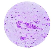 Photomicrograph showing Neurofibroma. Neurofibromatosis, is a genetic disorder, gene mutations. photo