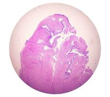 histología de uracal quiste. microfotografía de histológico manchado diapositiva demostración uracal quiste. uretral quiste. foto