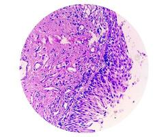 Histology of urachal cyst. Photomicrograph of histological stained slide showing Urachal cyst. Urethral cyst. photo