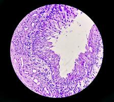 Histology of urachal cyst. Photomicrograph of histological stained slide showing Urachal cyst. Urethral cyst. photo